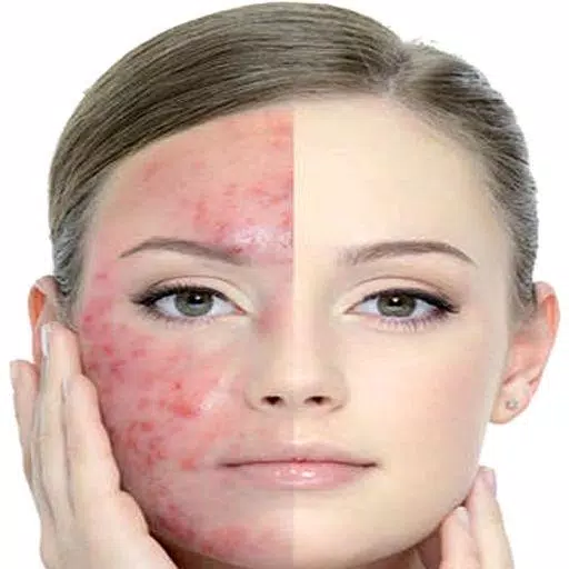 Get Rid of Acne  (Guide) Скриншот 1